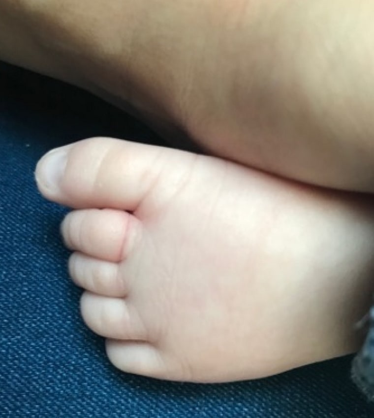 Mother's hair wrapped around her son's toe, cutting off circulation.