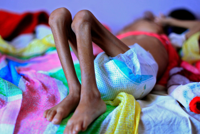 A Yemeni child suffering from malnutrition lies on a bed at a treatment center in a hospital in the capital Sanaa on Oct. 6, 2018