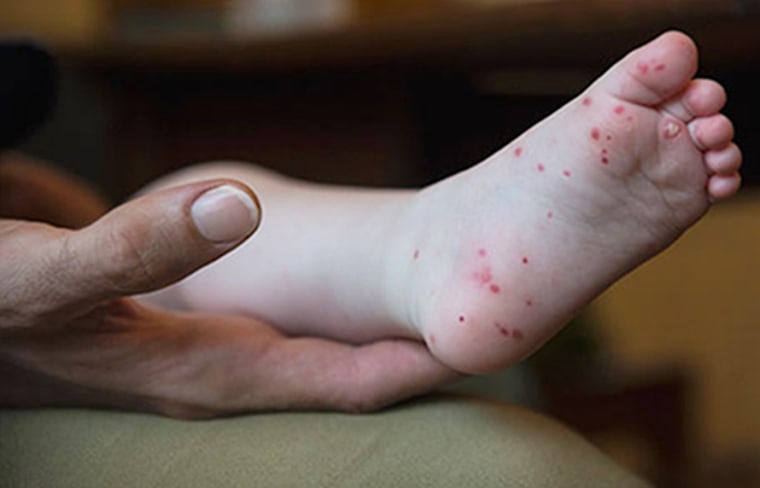 Hand, foot and mouth disease plagues college campuses