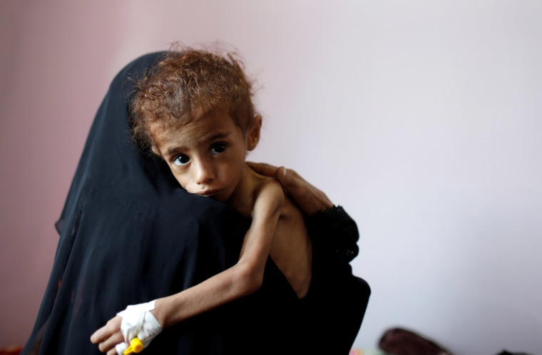 Image: A woman holds a malnourished boy at a hospital in Sanaa, Yemen