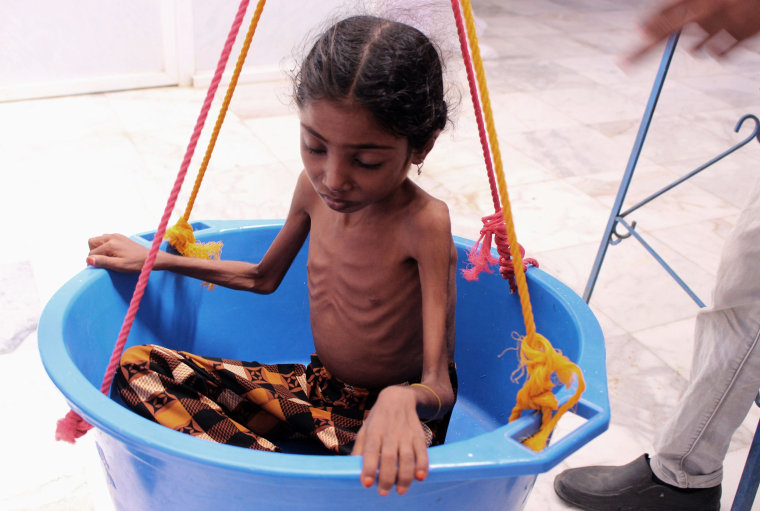 A girl suffering from severe malnutrition is weighed at a treatment center in a hospital in Yemen