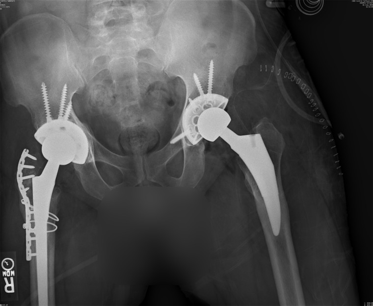 An X-Ray of Andrew Chappell's hip