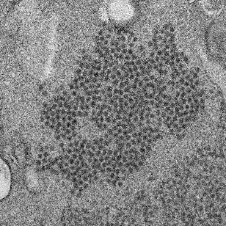 A microscopic image of Enterovirus-D68 virions. EV-D68 may be tied to the paralyzing illness acute flaccid myelitis.