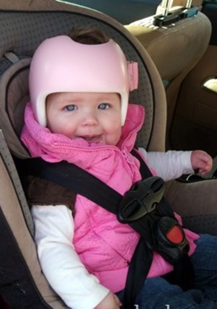 My daughter, Kennedy, wore a helmet 8 years ago to correct a flat spot on her head.