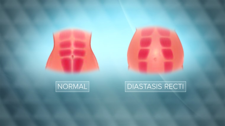 What is Diastasis Recti?