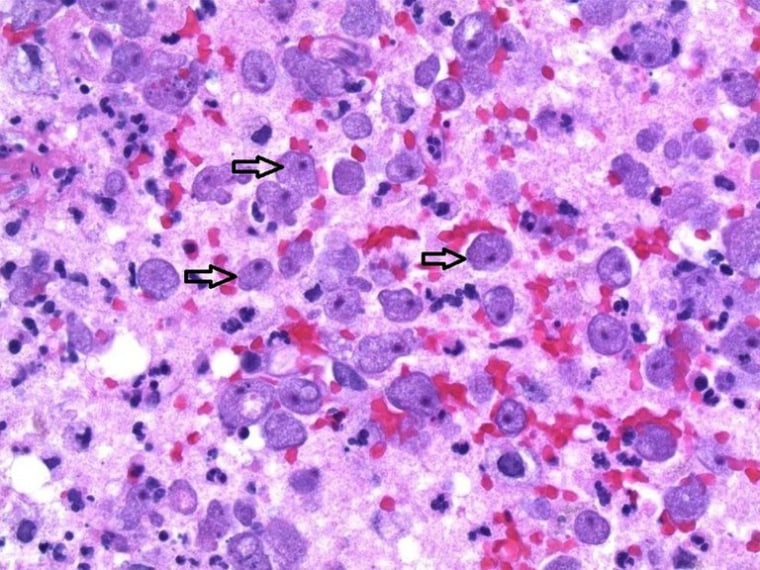 Image: Arrows point to the amoebas in the Seattle woman's brain.