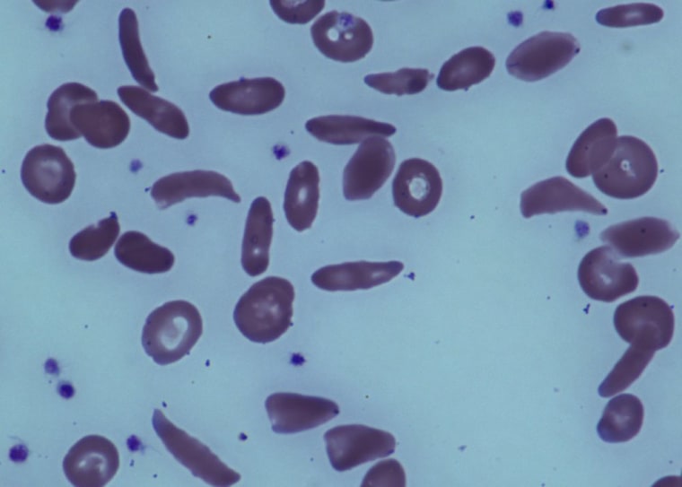 Image: Red blood cells in a patient with sickle cell disease at the National Institutes of Health Clinical Center in Bethesda