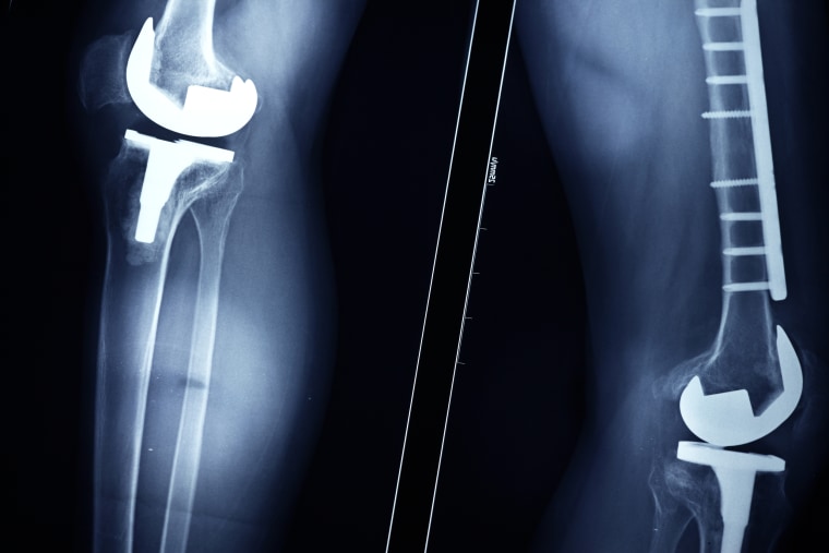 A digital X-ray following successful knee replacement surgery.