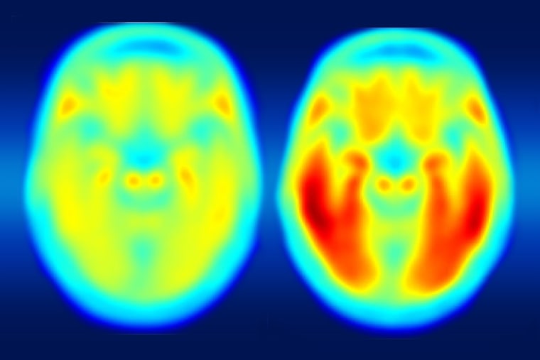 A study using a new PET imaging agent shows that measures of tau protein in the brain more closely track cognitive decline due to Alzheimer's disease
