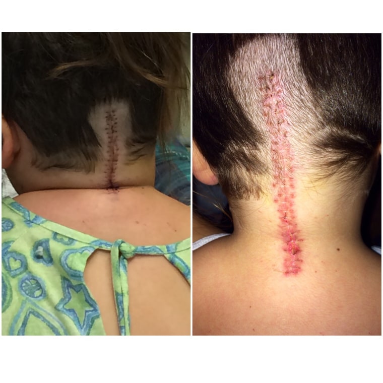 Mazie had brain surgery to treat her Chiari malformation.