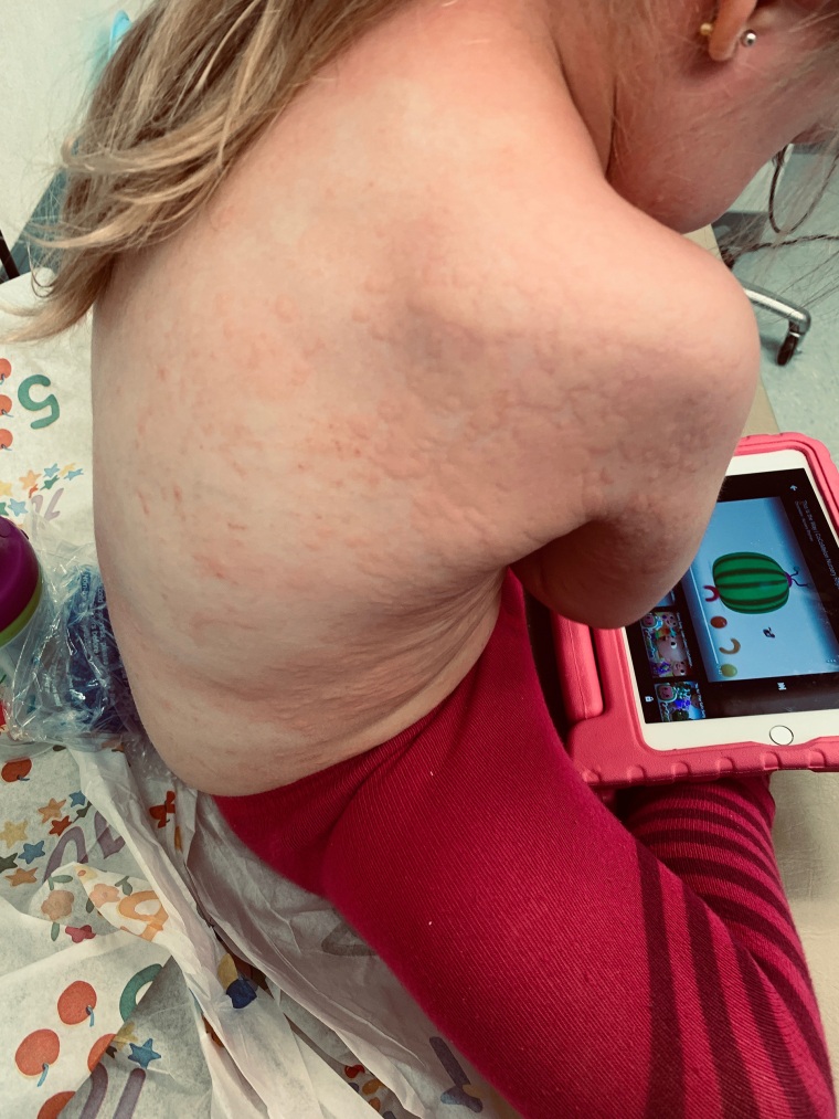When Maren first started having an allergic reaction it seemed very mild. As soon as it escalated she received an epinephrine shot, which her mom, Julie Berghaus, believes made a huge difference. 