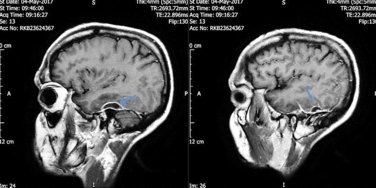 MRI brain images show two "discrete" abscesses in the man's skull doctors say developed after a cotton swab became lodged in the man's ear.