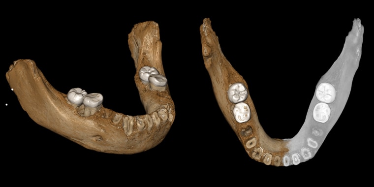 Two views of a virtual reconstruction of the Xiahe mandible. At right, the simulated parts are in gray. According to a report, the bone is at least 160,000 years old.