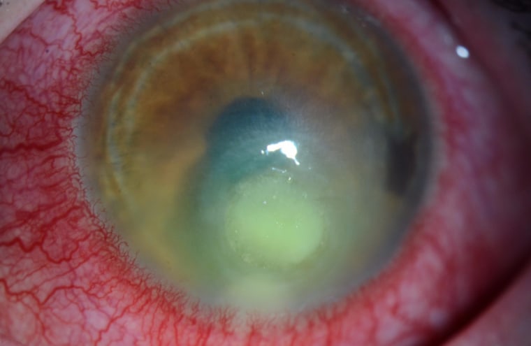 After swimming and sleeping in his contacts, a 34-year-old man developed bacterial and viral infections in his eye.