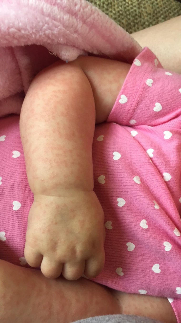 measles baby