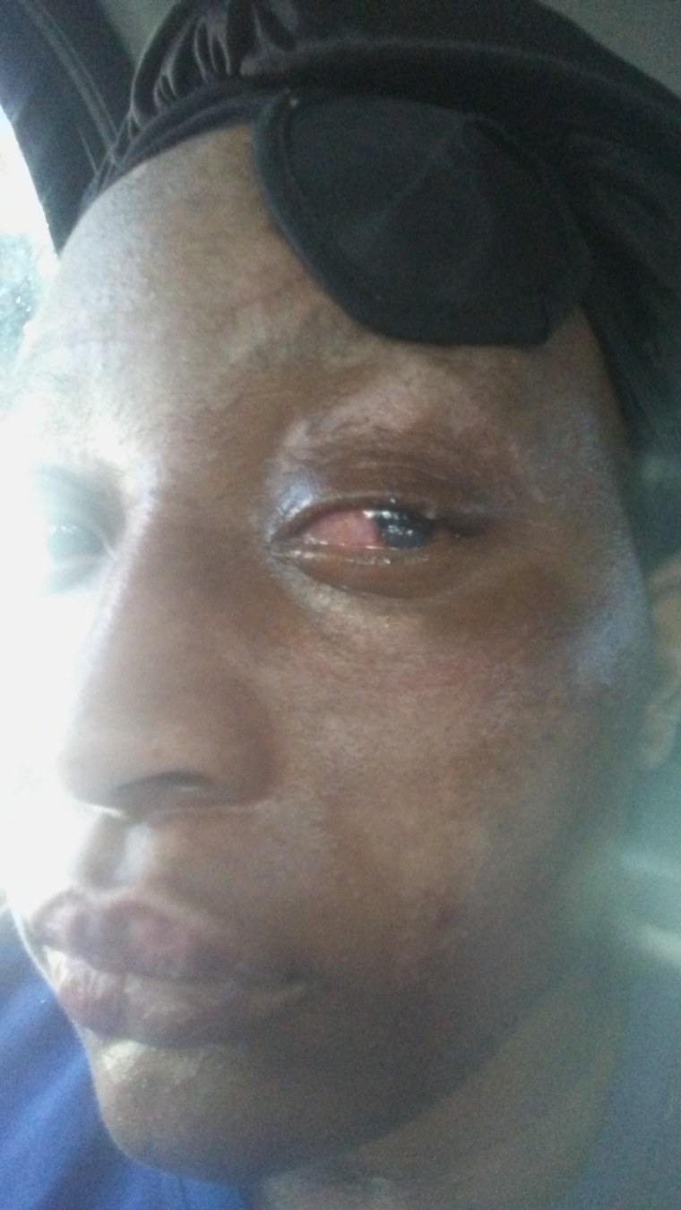 Y'tesia Taylor shows her eye which was burned when a can of PAM exploded in her kitchen.