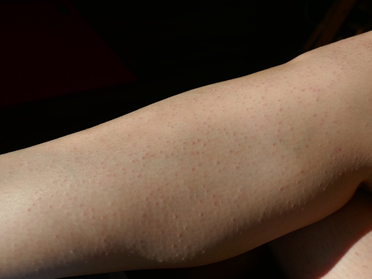 Razor bumps can resemble acne.