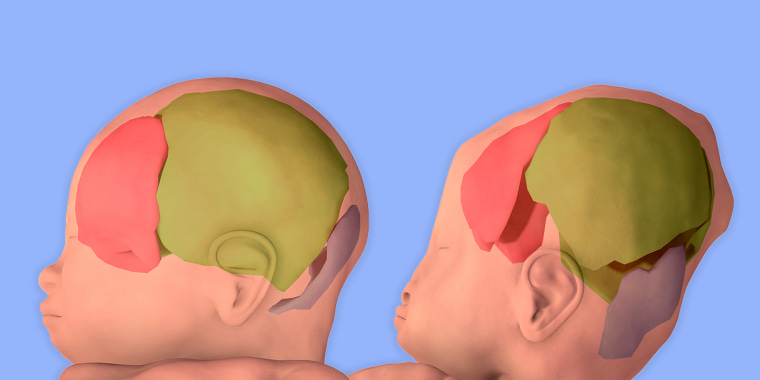 baby's head after birth
