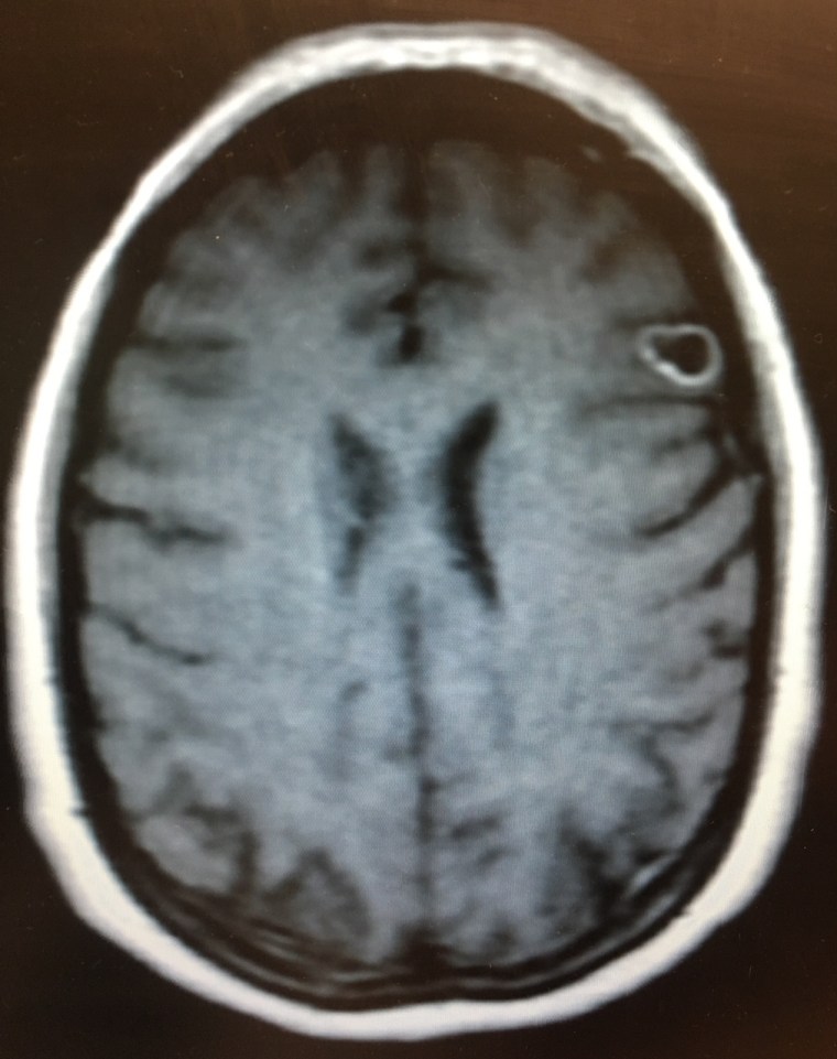 An MRI shows Rachel Palma's "brain tumor," which turned out to be a parasite.