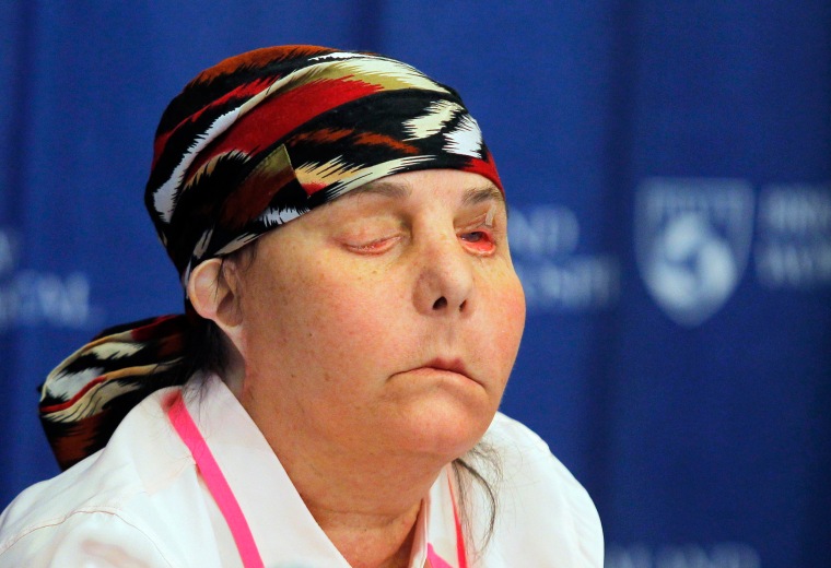 Image: Face transplant recipient Carmen Tarleton speaks at a news conference at Brigham and Women's Hospital in Boston