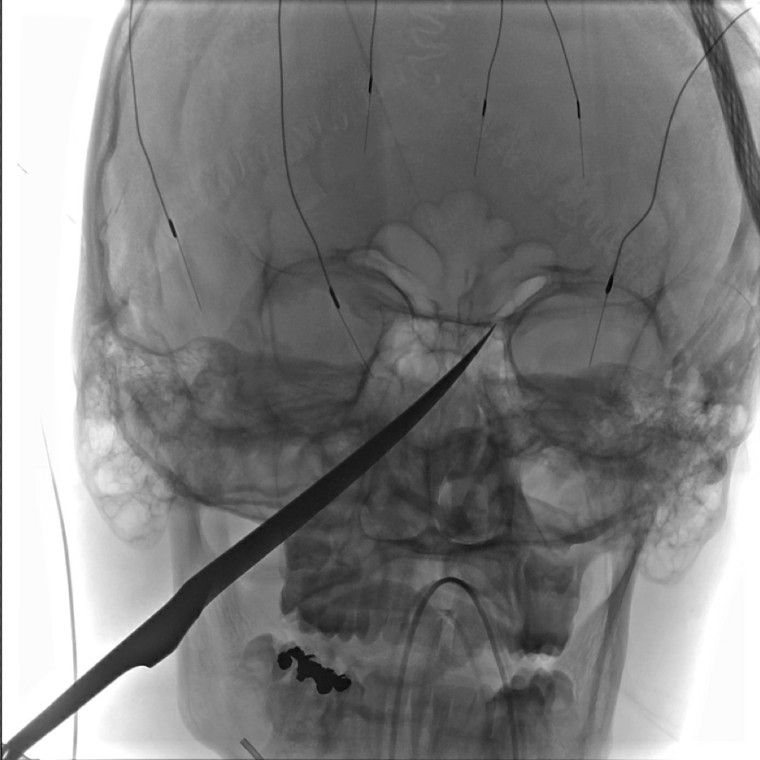 Boy impaled with knife in his face