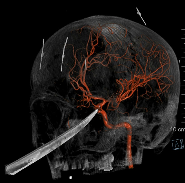 Image: A 3D computer rendering made from x-ray images show a 10 inch knife impaled in the skull of 15-year-old Eli Gregg.