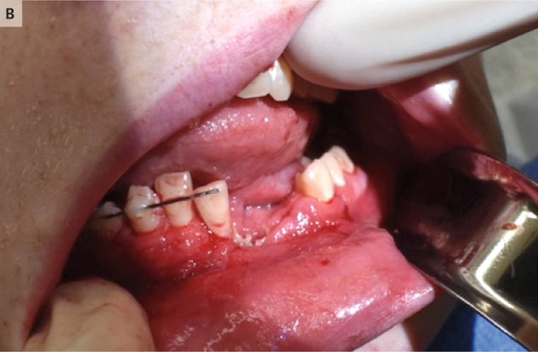 Image: e-cigarette mouth injury