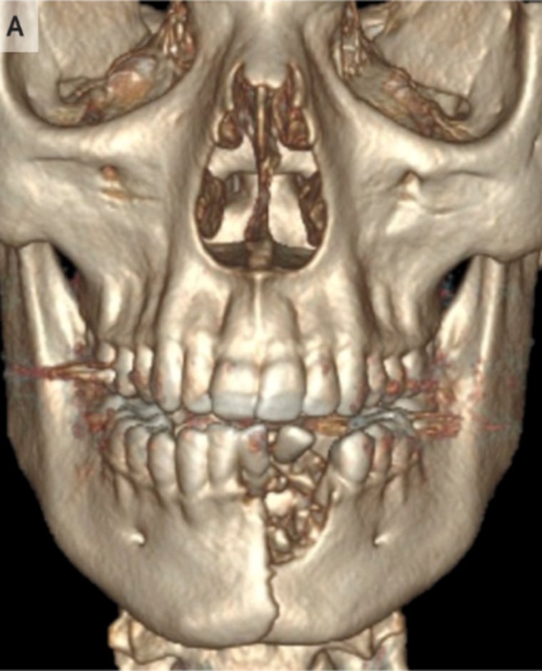 Image: CT scan e-cigarette mouth injury