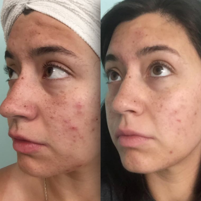Plenty of photos show the skin-clearing effect of the mask, including these before-and-after photos from one reviewer, who called the mask a "godsend."