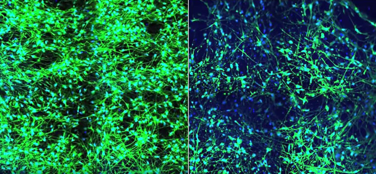 On the left, healthy brain tissue is full of nerve cells, highlighted in green. On the right, brain tissue with signs of inflammation.