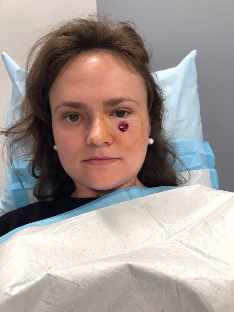 Performing surgery so close to the eye has a lot of challenges, but Gibson Miller's doctors were able to remove the cancer without affecting her eye. 