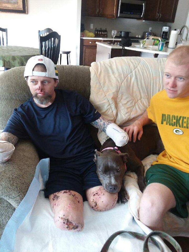 man who lost all his limbs and his nose from a dog lick infection