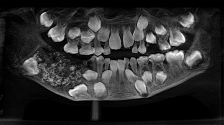 Doctors at the Saveetha Dental College and Hospital found 526 teeth-like structures after performing surgery on a 7-year-old boy's jaw in Chennai, India.