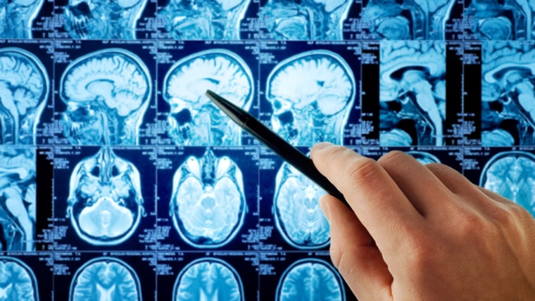 What Causes Brain Tumors Brain Tumor Treatment Prognosis And More