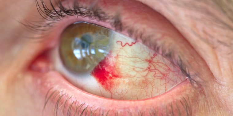 Eye hemorrhage