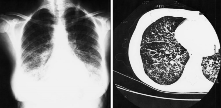 Image: X-ray's from the first known documentation of vaping-related lipoid pneumonia, found in a Canadian woman in 2000.