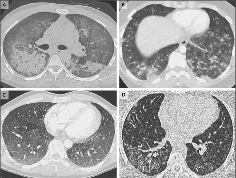 Computed tomographic scans of the chest obtained from patients with vaping-associated lung injury