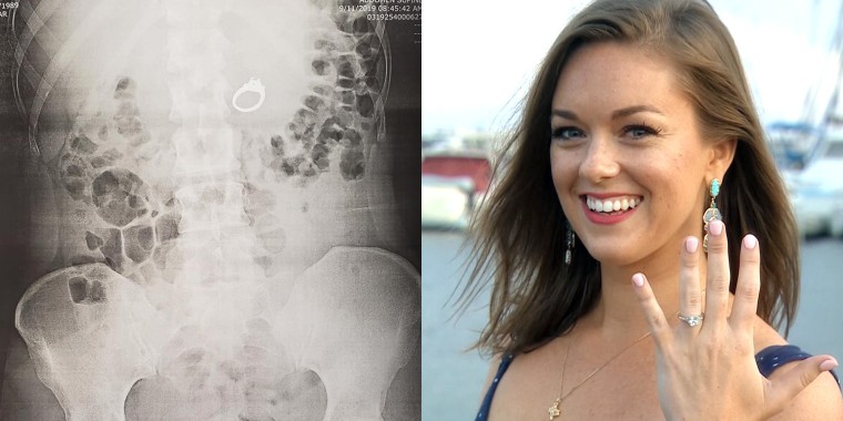 Woman who swallowed engagement ring