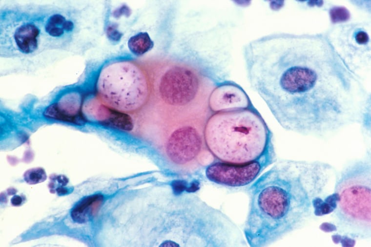 Image: A human pap smear showing chlamydia in the vacuoles.