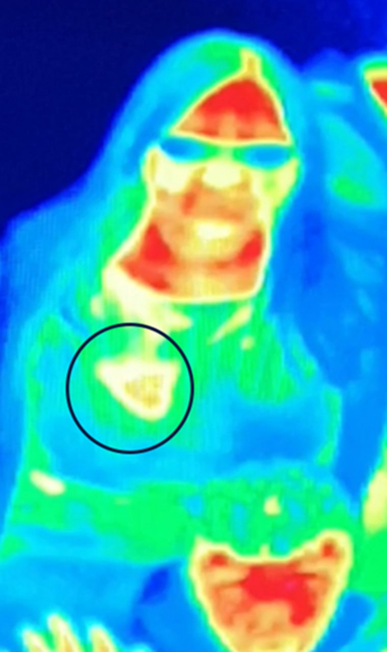 Bal Gill went into the museum's thermal imaging camera room, where she noticed one of her breasts was a different color.