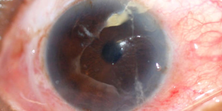 An inflamed eye with a corneal abrasion.