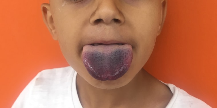 The boy's tongue remained purple three and a half hours after doctors successfully unstuck the bottle. He later recovered fully.