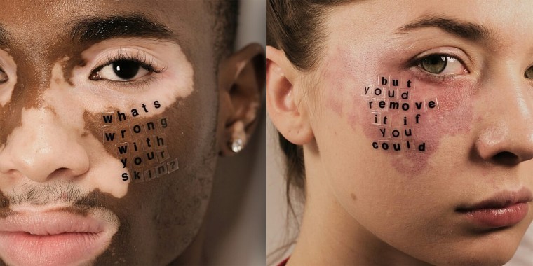 Models with skin conditions answer hurtful questions in powerful portrait  series