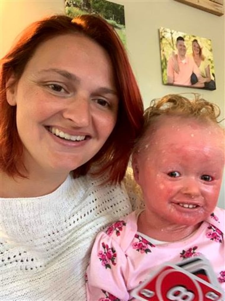 Jennie Riley and her daughter, Anna, who suffers from harlequin ichthyosis.