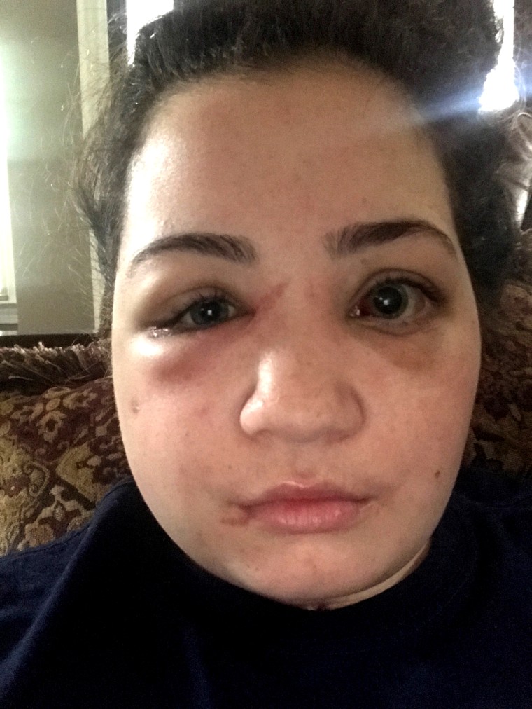 Sabrina Rosado's eye sockets were broken during the drunk driving accident. When she had problems seeing, she thought the excessive swelling in her face was causing it. Later she learned she ruptures in her eyes impacting her vision. 