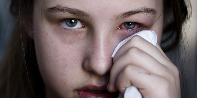 Girl holding tissue to her pink eye
