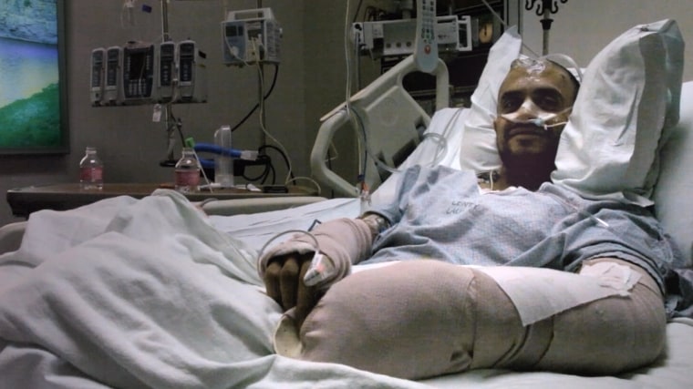 After a bizarre accident, chef Eduardo Garcia underwent 18 surgeries, including an amputation. 