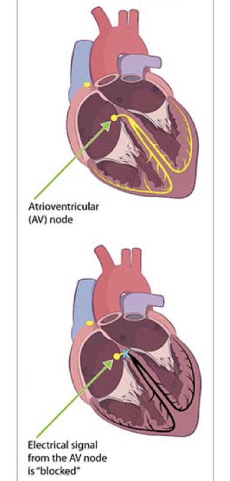 The AV node is disabled during heart block.