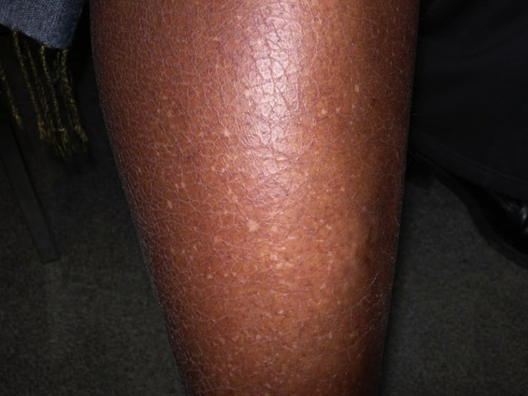 white spots on skin are called idiopathic guttate hypomelanosis