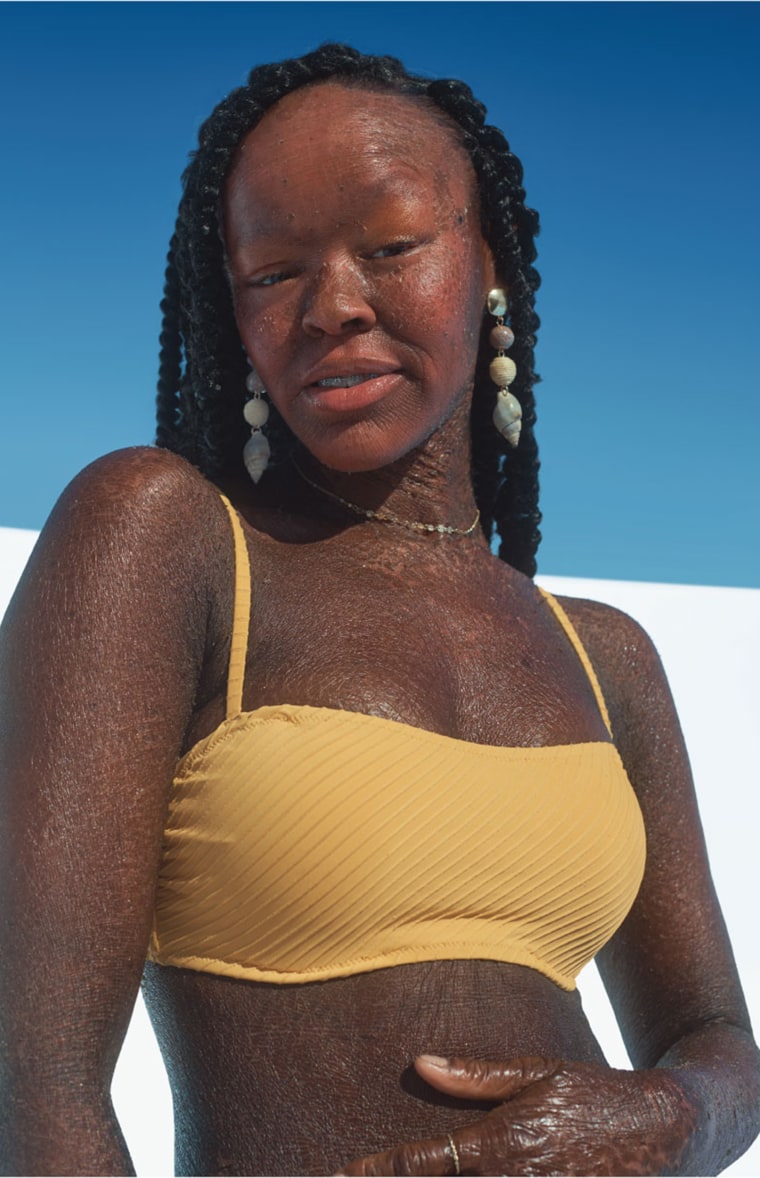Model Jeyza Gary rocks a yellow bikini for Target's 2020 swimwear campaign. She has a rare skin condition called ichthyosis.